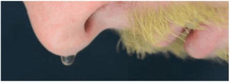 thin yellow fluid leaking from nose|3 Simple Ways to Identify CSF Rhinorrhea